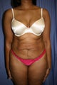 Tummy Tuck