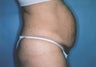 Post Pregnancy Abdominoplasty