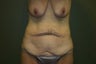 Tummy Tuck