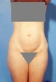 Abdominoplasty
