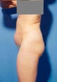 Abdominoplasty