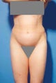Abdominoplasty