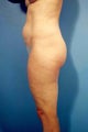 Abdominoplasty