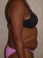 Tummy Tuck
