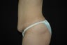 Tummy Tuck