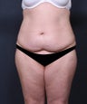 Tummy Tuck