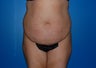 Tummy Tuck