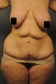  Abdominoplasty, abdominal and flank liposuction, beltlipectomy, bilateral mastopexy