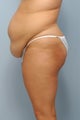 Tummy Tuck