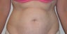 Abdominoplasty 