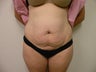 Abdominoplasty/Tummy Tuck 