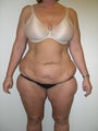 Abdominoplasty/Tummy Tuck 