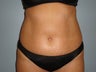 Tummy Tuck