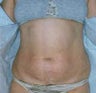 Tummy Tuck