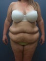 Tummy Tuck