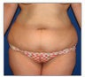 Tummy Tuck- Abdominoplasty