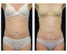 Abdominoplasty - Tummy Tuck
