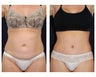 Abdominoplasty - Tummy Tuck