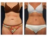 Abdominoplasty - Tummy Tuck