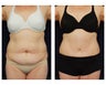 Abdominoplasty - Tummy Tuck
