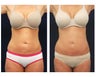Abdominoplasty - Tummy Tuck