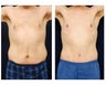 Abdominoplasty - Tummy Tuck