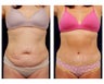 Abdominoplasty - Tummy Tuck