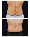 Abdominoplasty - Tummy Tuck