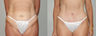 Abdominoplasty