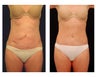 Abdominoplasty - Tummy Tuck