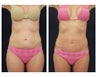 Abdominoplasty - Tummy Tuck