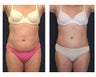 Abdominoplasty - Tummy Tuck