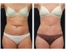 Abdominoplasty - Tummy Tuck