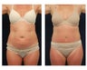 Abdominoplasty - Tummy Tuck
