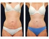 Abdominoplasty - Tummy Tuck