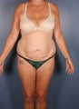 Tummy Tuck, Liposuction