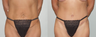 Abdominoplasty