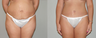 Abdominoplasty