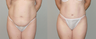 Abdominoplasty