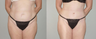 Abdominoplasty