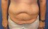 full abdominoplasty