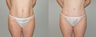 Abdominoplasty