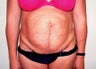 Tummy Tuck