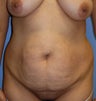 Tummy Tuck