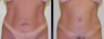 Tummy Tuck