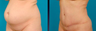Tummy Tuck