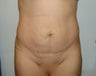 tummy tuck