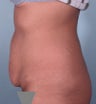 Tummy tuck