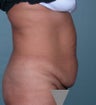 tummy tuck