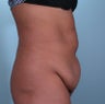 tummy tuck